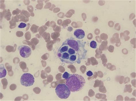 Bone Marrow Biopsy Findings Microscopic Findings Of Bone Marrow