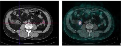 68Ga DOTATOC PET CT Scan A Computed Tomography CT And B Fused