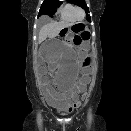 Cecal Volvulus Image Radiopaedia Org