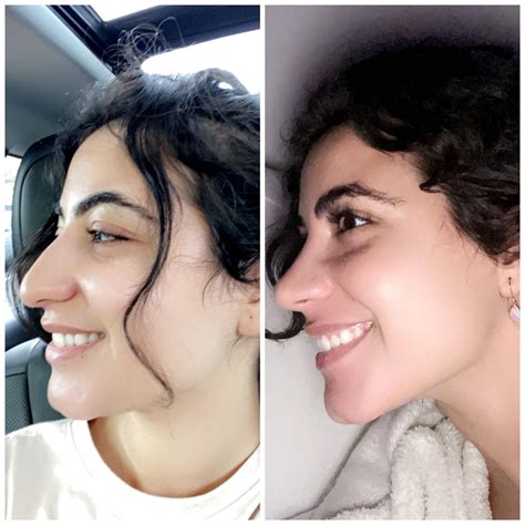 Before And After 6 Months Rhinoplasty Side Profile Rplasticsurgery