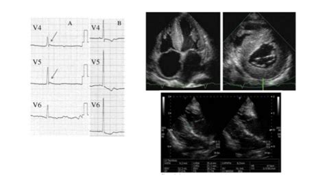 left ventricular diastolic dysfunction  echocardiography