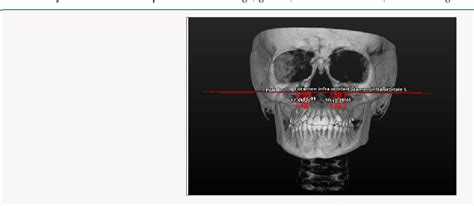 Figure 1 From The Evaluation Of Limit Of Superior Repositioning Of