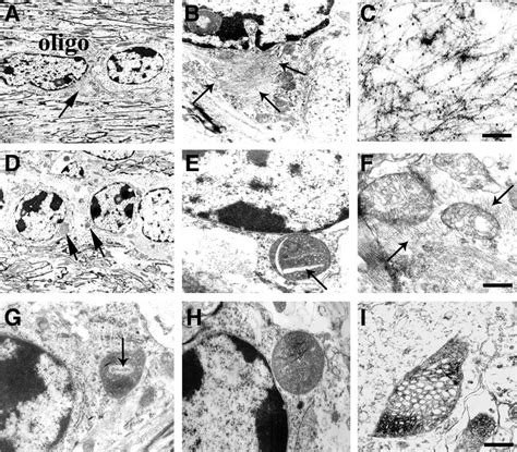 Ultrastructural Analysis Of The Neuropathological Alterations In Mbp