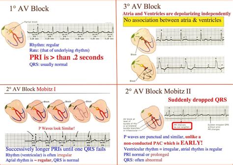 Atrioventricular block:In atrioventricular (AV) block, or heart block ...