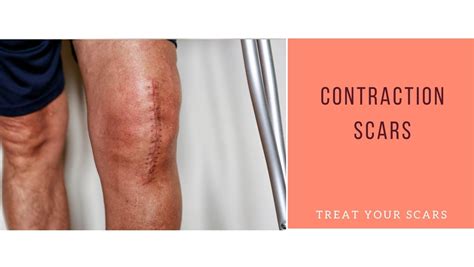 Contraction-scars - Treat Your Scars