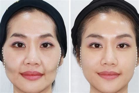 Tiêm filler má có an toàn không Tác dụng phụ thường gặp