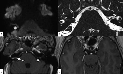 A Axial Diffusion Weighted Images DWI Sequence Shows A Bright Signal