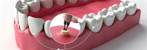 Surfacage Radiculaire Par Sextant Tout Savoir Avant