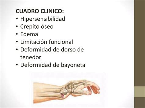 Fracturas De Radio Distal Ppt