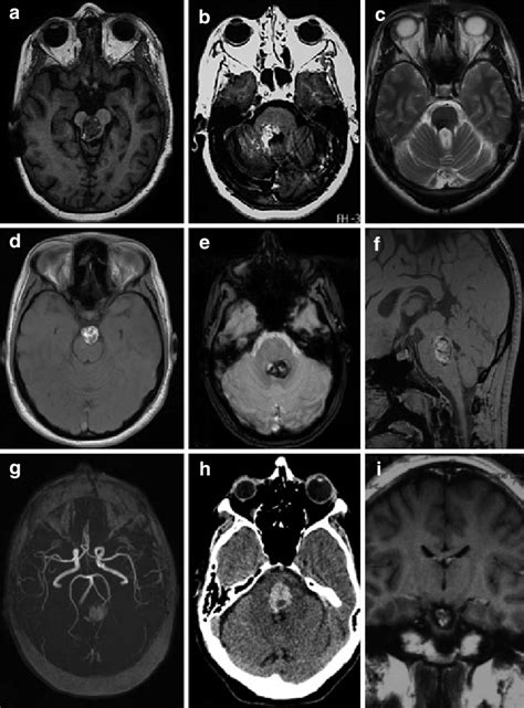 Brainstem Cavernomas In Different Evolutive Stages A T Weighted