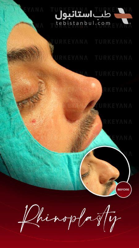 Guide Complet De La Rhinoplastie Istanbul Prix Traitement