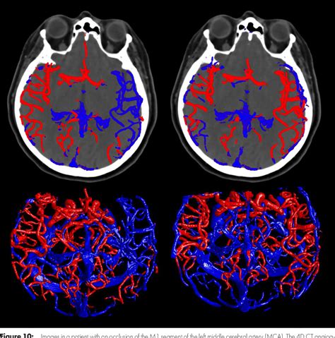 Figure From Cerebral Artery And Vein Segmentation In Four