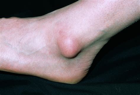 Bursa On Ankle Photograph By Dr P Marazzi Science Photo Library