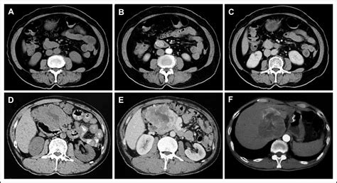 Duodenal Gastrointestinal Stromal Tumor Clinicopathological Characteristics Surgical Outcomes