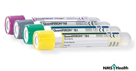 Tb Testing The Differences Between Quantiferon Gold Quantiferon Gold