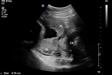 Ultrasound Placenta Previa Movie 1 Embryology