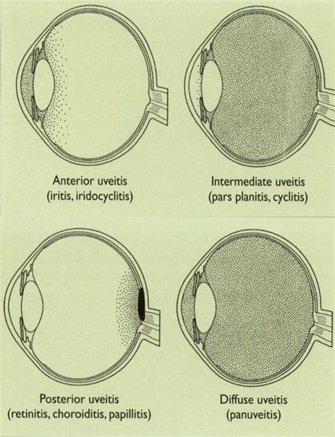 Sun Working Group Anatomic Classification Of Uveitis Jabs Download Scientific Diagram