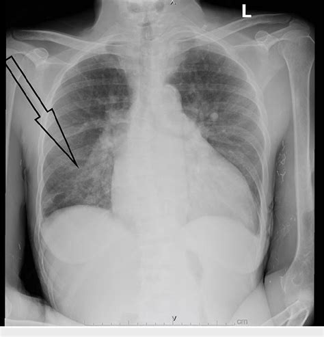 Figure From Staphylococcus Lugdunensis Infective Endocarditis With