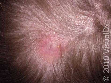 Tinea Capitis Scalp Ringworm Causes Symptoms And Off