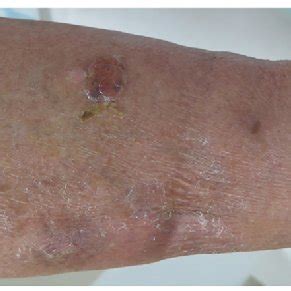 The Clinical Picture Of Case Edema And Multiple Tense Bullae Of Left