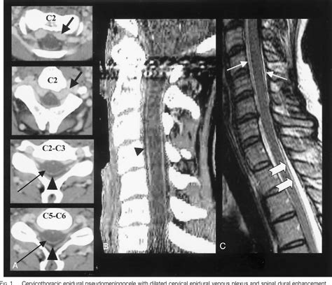 Pdf Intradural Spinal Vein Enlargement In Craniospinal Hypotension