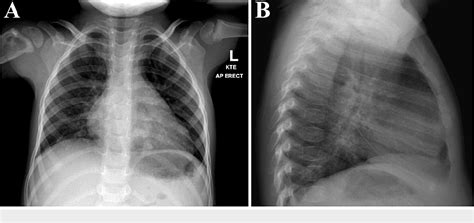 Figure 2 From Tuberculosis Osteomyelitis As An Indolent Bone Mass Semantic Scholar