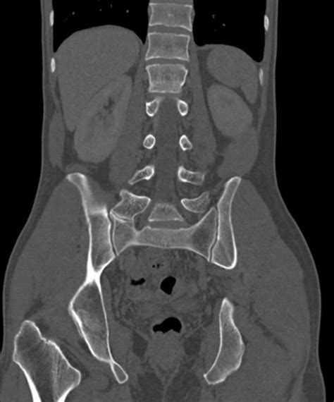 Lumbosacral Transitional Vertebra Image