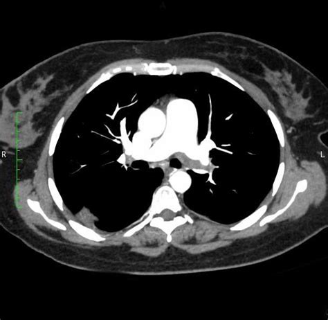 Chest CT Angiography Showing An Embolism In The Major Pulmonary