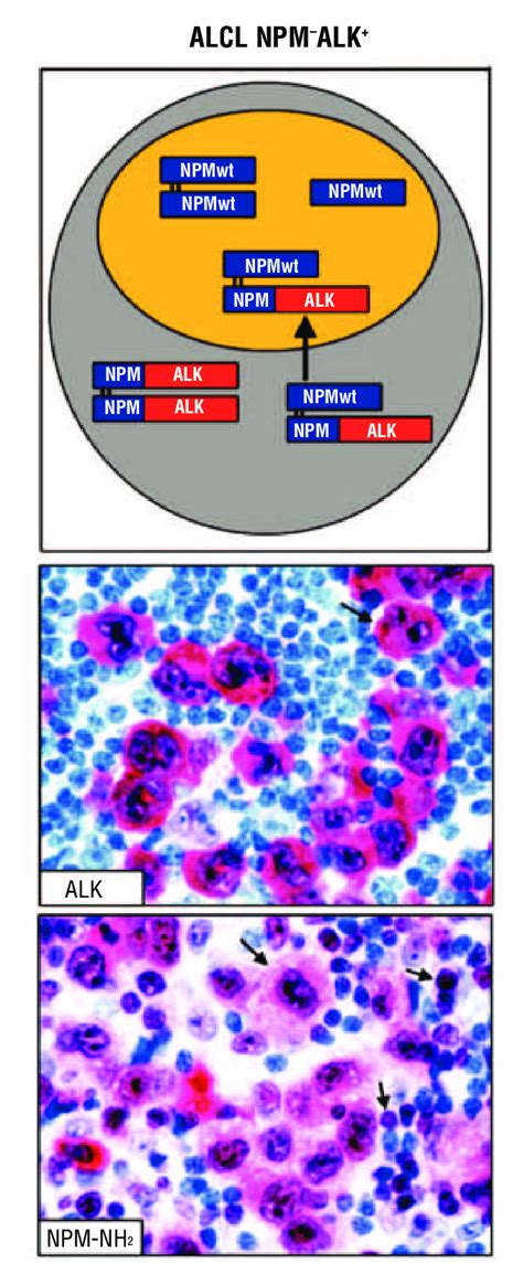 Localization Of Wild Type NPM And NPM ALK Fusion Protein In ALCL With