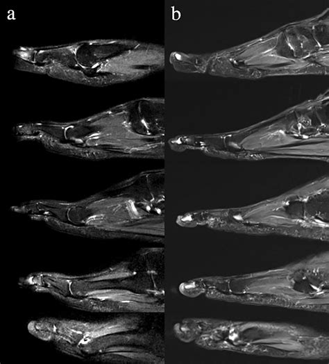 Figure 1 From Raynaud S Phenomenon Manifesting As Progressive Abnormal