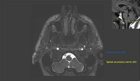 CaseStacks.com - Cranial Nerve Anatomy on MRI