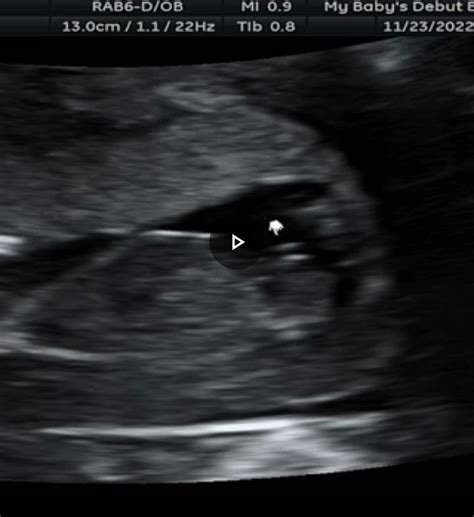 Boy or girl ultrasound | BabyCenter