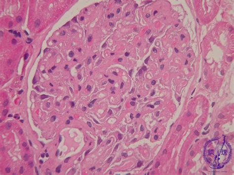 Membranous Nephropathy Histology