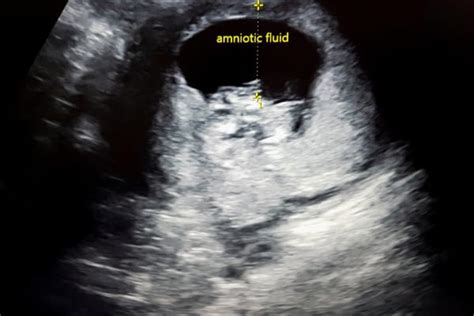 Afi Amniotic Fluid Index Lesame Per Valutare Il Liquido Amniotico