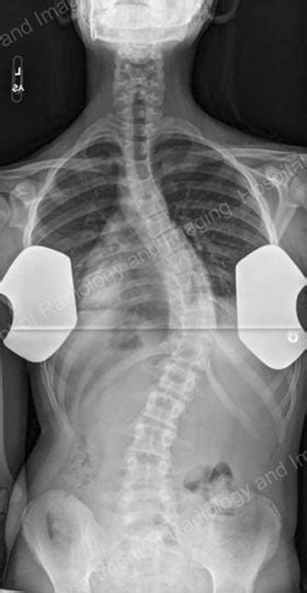 Adolescent Idiopathic Scoliosis An Overview