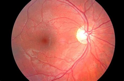 Imaging Of The Optic Nerve What Is It And Why Is It Needed Glaucoma