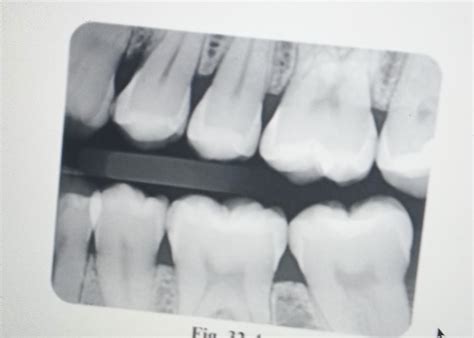 Solved Identify the interproximal caries on this image. List | Chegg.com