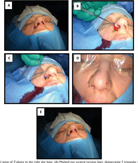 Figure 1 From Z Plasty Of The Alar Subunit To Correct Nasal Vestibular