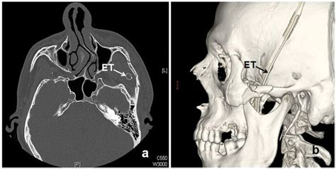 radiologic views  case   postoperative  day   axial cts