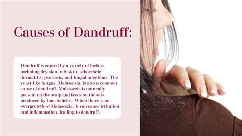 Ppt Shampoo For Dandruff Powerpoint Presentation Free Download Id 12079465