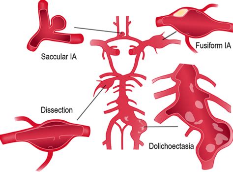 Types Of Saccular Aneurysm