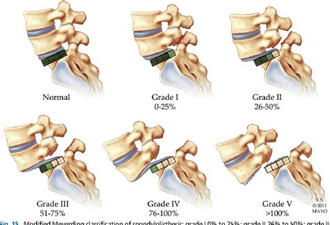 Anterolistesis