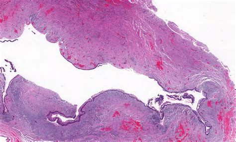 Pathology Outlines Ameloblastoma