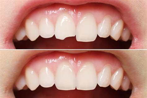 Veneers Cost Top 8 Factors That Affect Cost And How To Save