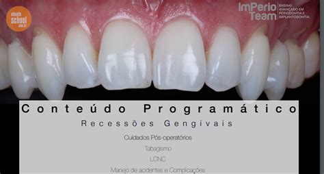 Manejo Tecidual Periodontal E Peri Implantar Odonto School