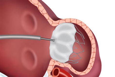 Improving Heart Patients Lives With Left Atrial Appendage Laa