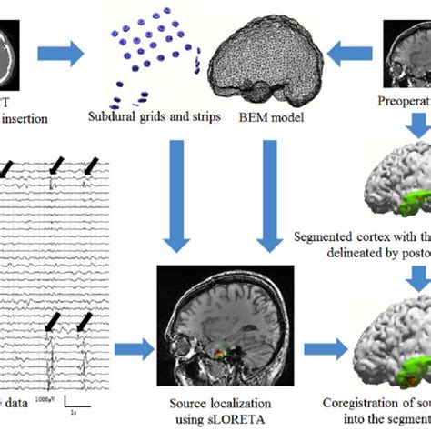 A Schematic Illustration Of The Procedures Of Ecog Source Localization