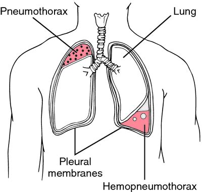 Punctured lung | definition of Punctured lung by Medical dictionary