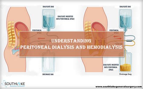 Peritoneal Dialysis Vs Hemodialysis