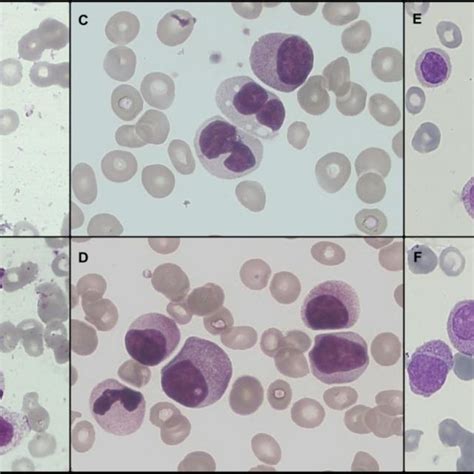 Aandb Case 1 Abnormal Promyelocytes With Rounded Nuclei And Dense Download Scientific Diagram